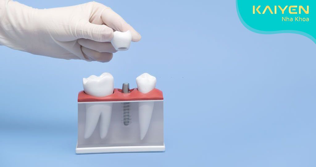 Thực hiện gắn răng tạm trên Implant cần được bác sĩ chỉ định