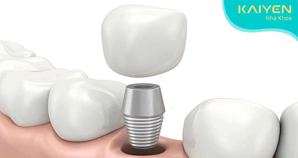 Phương pháp đặt răng tạm tháo lắp dành cho bệnh nhân mất nhiều răng