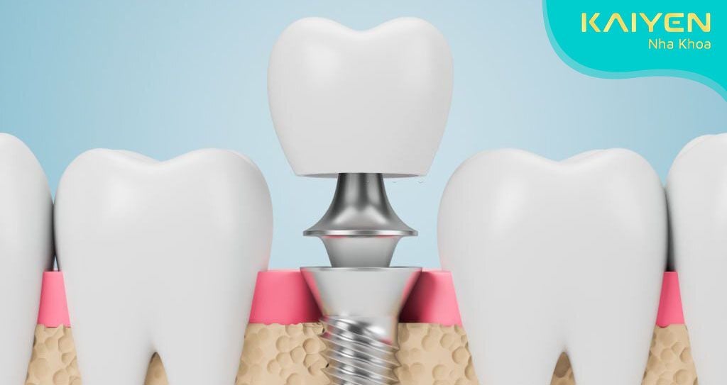 Răng tạm trên Implant là gì? Có mấy loại? Ưu nhược điểm chi tiết