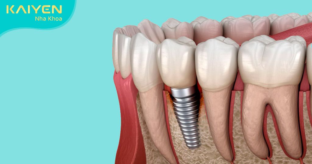 Biến chứng khi trồng răng Implant kém chất lượng