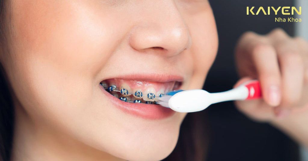 Rớt mắc cài niềng răng nếu bạn đánh răng quá mạnh hoặc dùng bàn chải quá cứng
