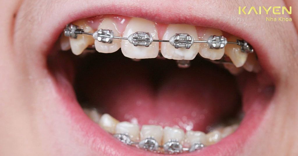 Độ đàn hồi của dây thun bị suy giảm dễ xảy ra tình trạng rớt mắc cài niềng răng