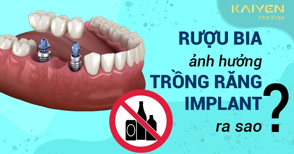 Sử dụng rượu bia ảnh hưởng đến trồng răng Implant thế nào? – Nha ...