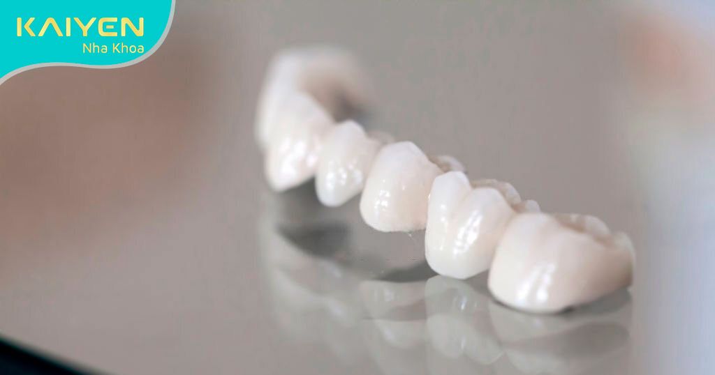 Răng sứ katana – răng sứ Nhật Bản