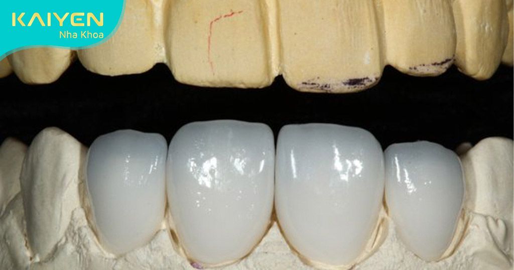 Răng sứ Cercon có tính thẩm mỹ cao hơn