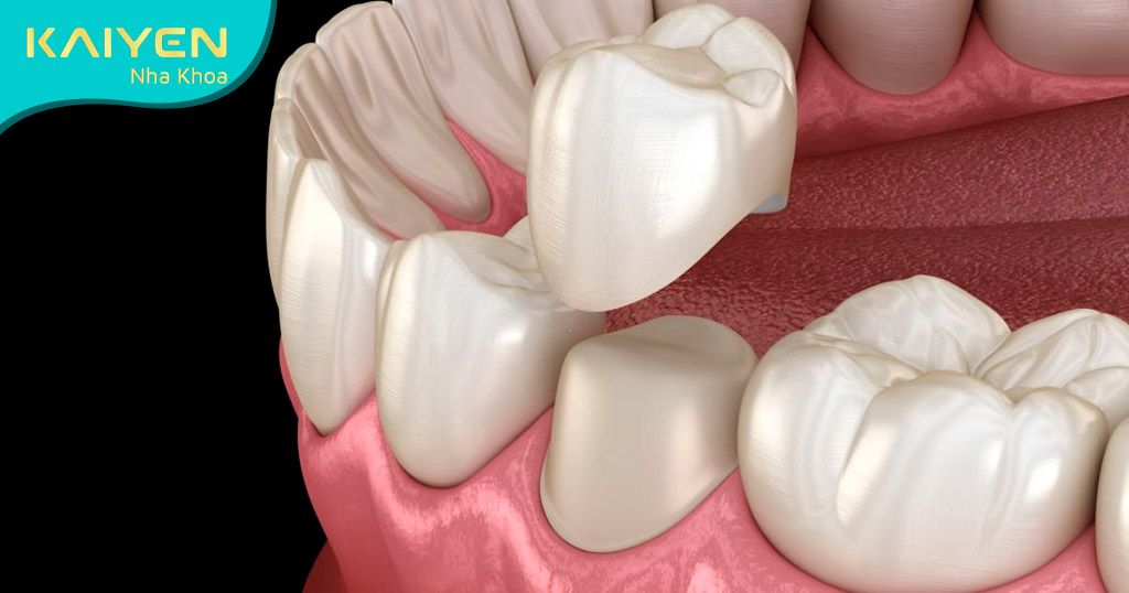 Bọc răng sứ khôi phục thẩm mỹ cho hàm răng