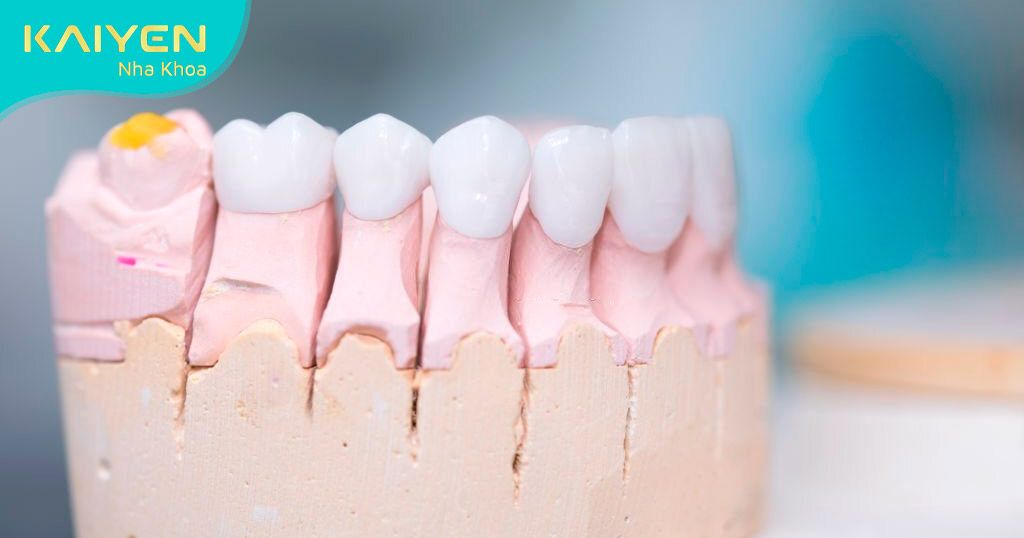Răng toàn sứ màu sắc trắng trong tự nhiên như răng thật