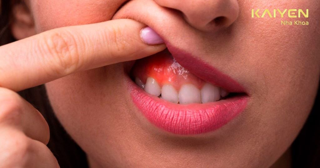 Sưng chân răng – Nguyên nhân do đâu?