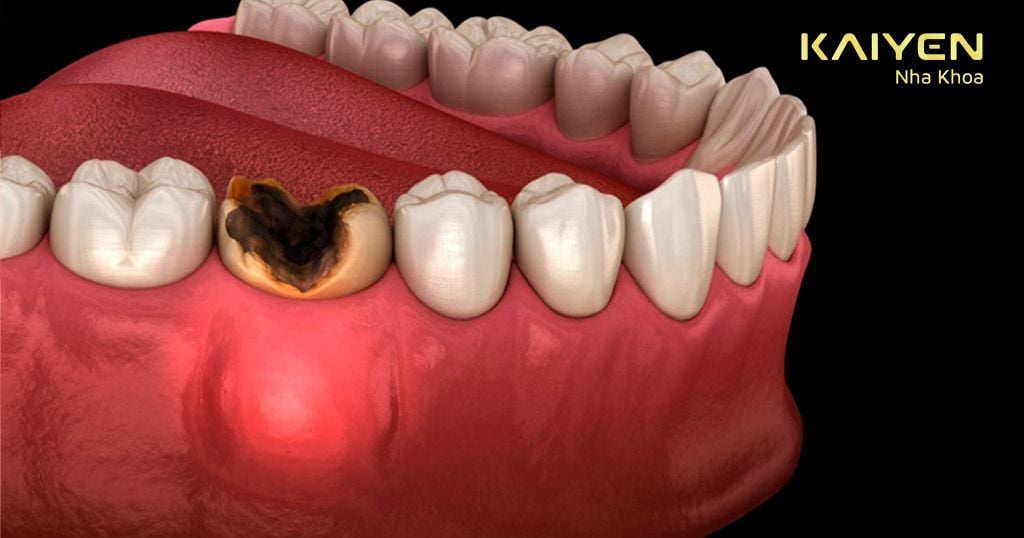 Vi khuẩn xâm nhập vào răng sâu và lan xuống vùng cuống răng gây sưng viêm