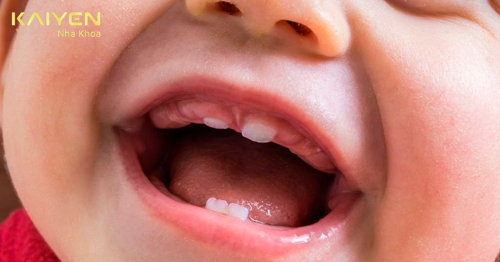 Trẻ mọc răng từ khoảng 5 tháng tuổi đến 32 tháng tuổi