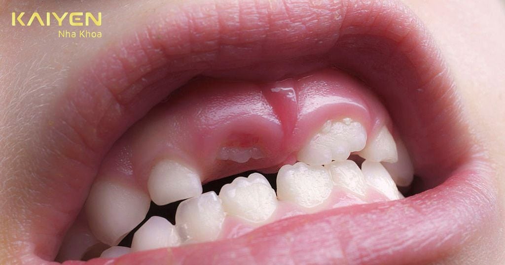Trẻ mọc răng có nhiều biểu hiện chảy dãi, ngứa nướu