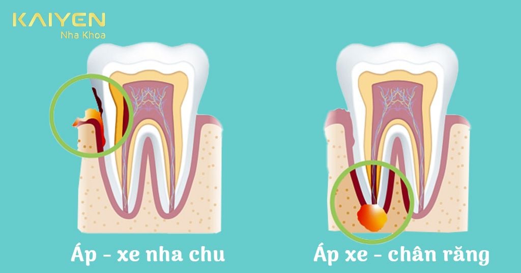 Sưng lợi răng khôn để lâu có thể dẫn đến áp xe răng