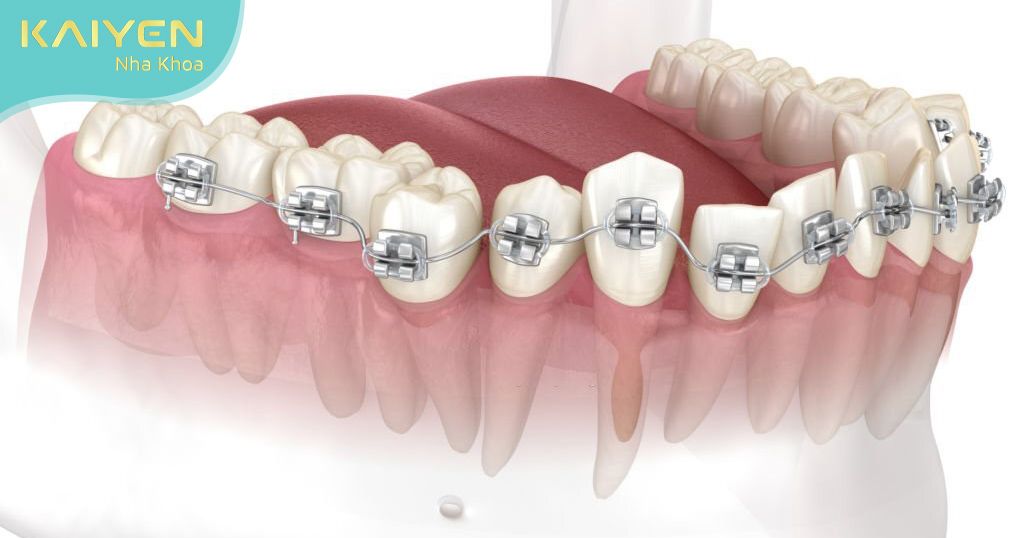 Bạn đã biết các tác hại của niềng răng chưa?