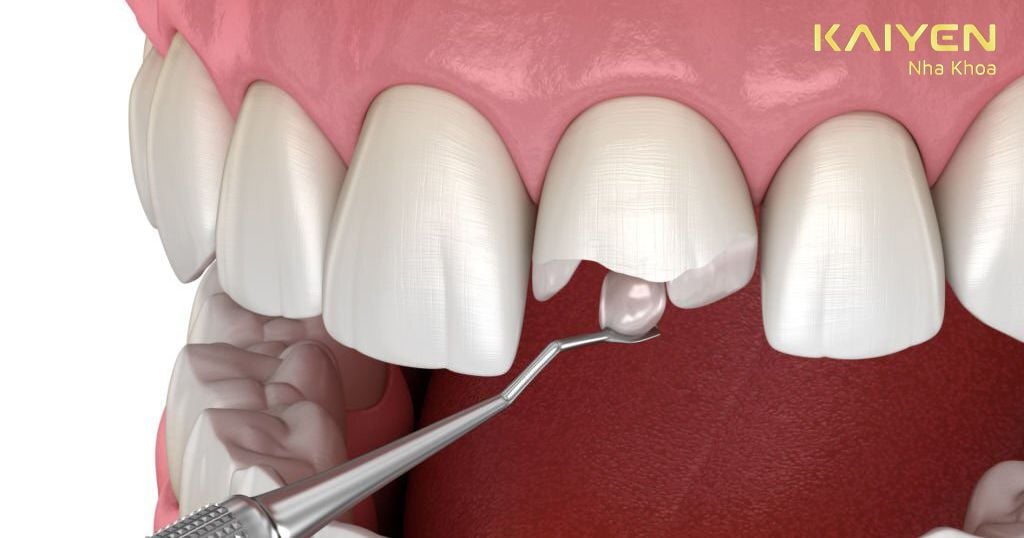Tác hại của việc trám răng sai kỹ thuật và tự trám răng tại nhà