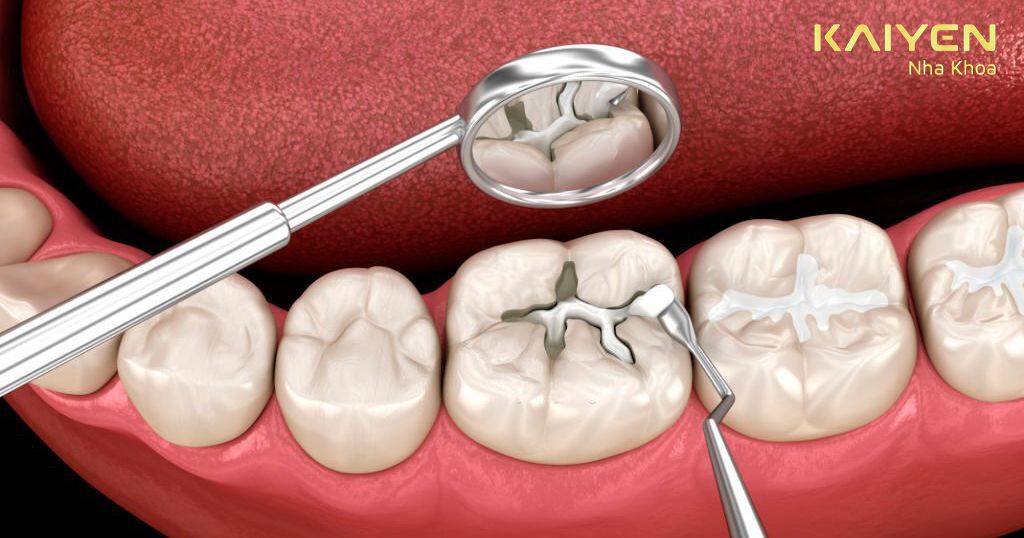 Trám răng bị sâu để bảo vệ sức khỏe răng miệng
