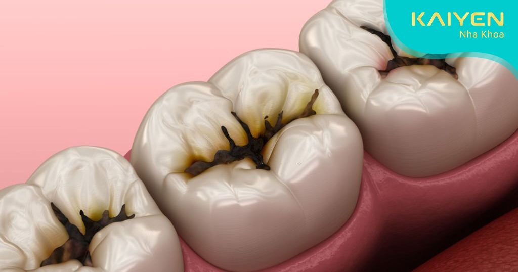 Sâu răng lân cận là tác hại của việc trám răng sai kỹ thuật