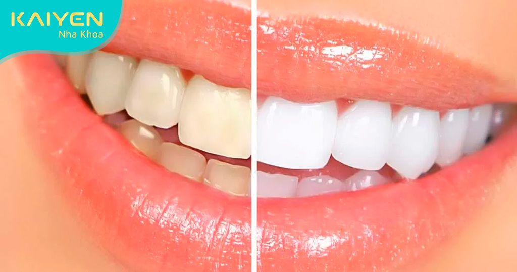 Tẩy răng ố vàng giá bao nhiêu phụ thuộc vào nhiều yếu tố