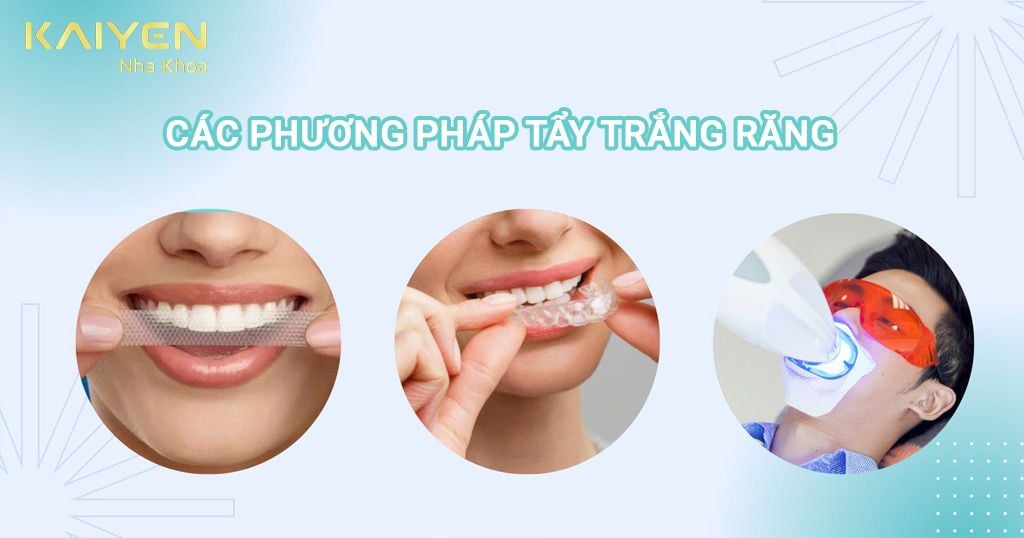 Mỗi phương pháp tẩy trắng răng khác nhau sẽ có mức giá khác nhau