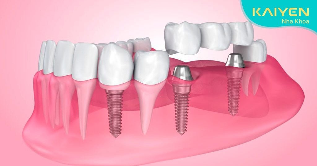 Cấy ghép Implant có cấu trúc tương tự răng thật