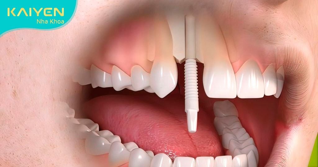 Cấy trụ Implant vào trong xương hàm