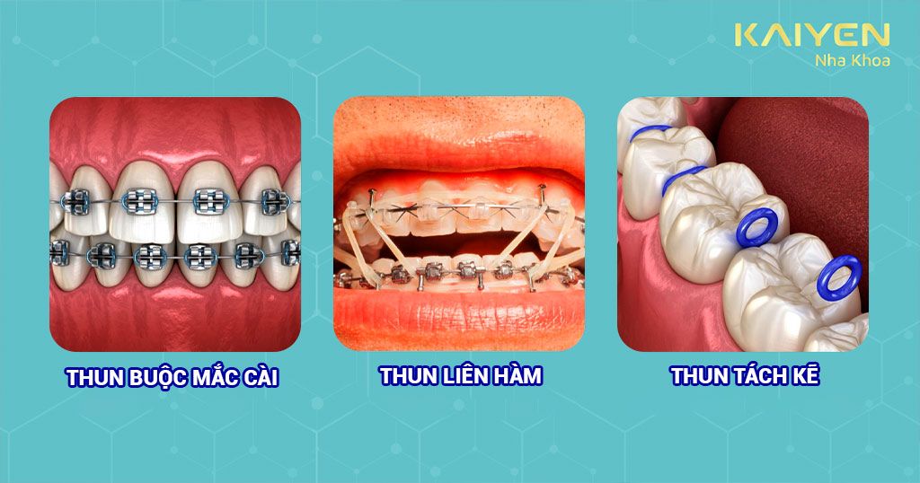 3 loại dây thun niềng răng phổ biến