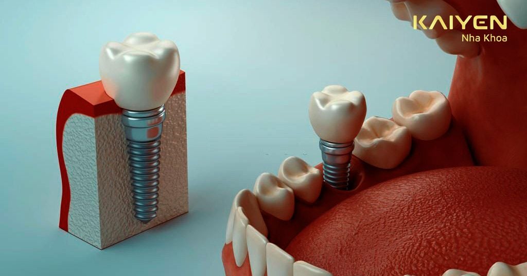 Tiêu chuẩn xương hàm trong cấy ghép Implant