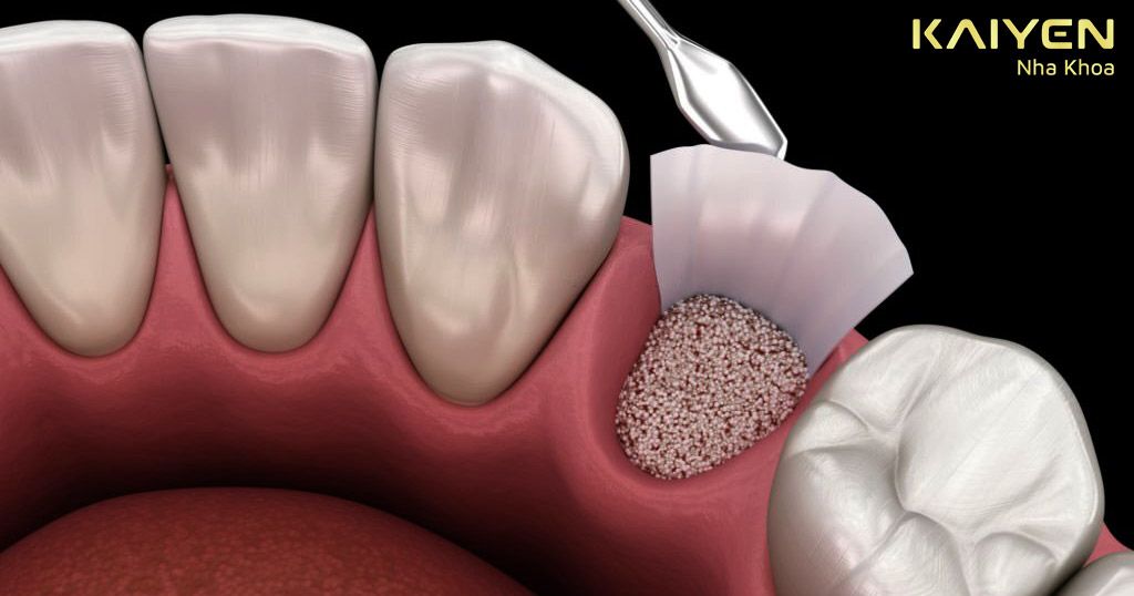 Trồng răng khi bị tiêu xương hàm trước hết phải tiến hành ghép xương và nâng xoang