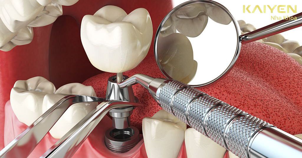 Trồng răng khi bị tiêu xương hàm bằng phương pháp cấy ghép Implant