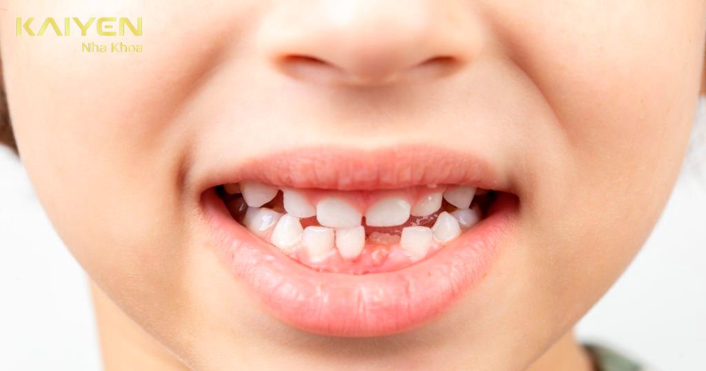 Răng sữa bị mất sớm khiến thay răng mọc lệch