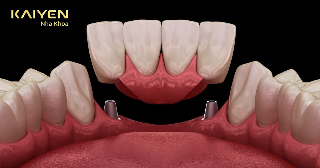 Trồng răng cửa bằng phương pháp cấy ghép Implant