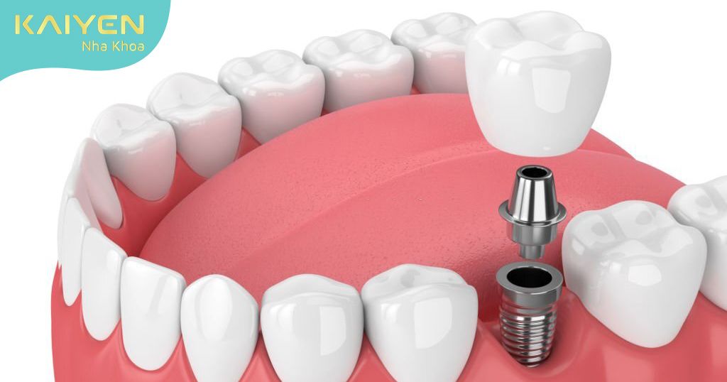 Trồng răng gãy bằng phương pháp cấy ghép Implant