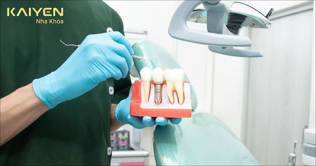 Trồng răng Implant là phương pháp được nhiều chuyên gia khuyên dùng hiện nay