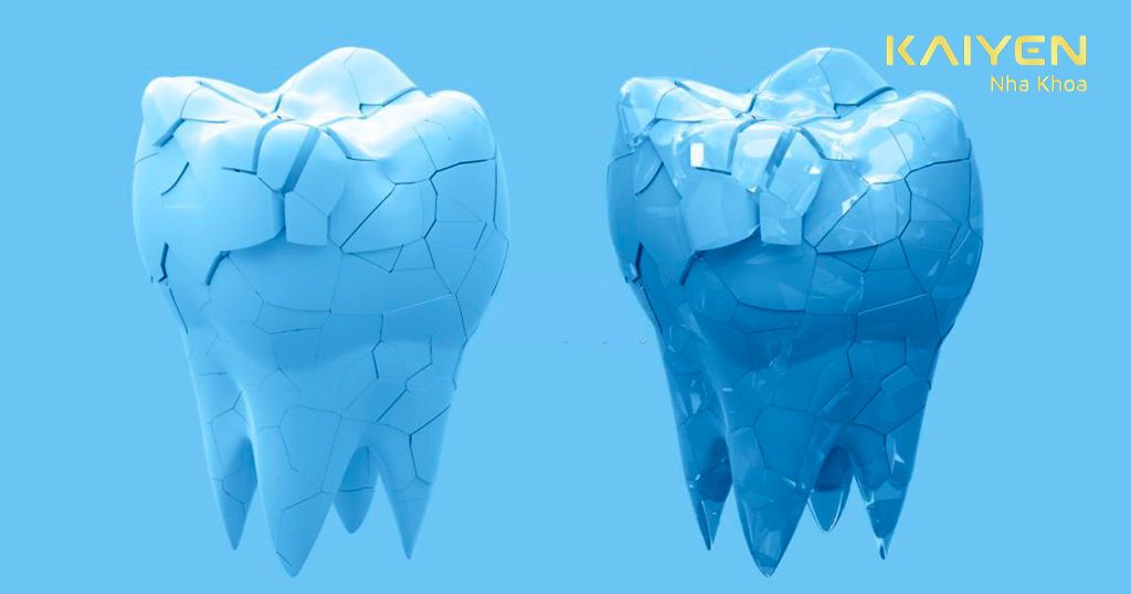 Răng bị sứt mẻ nặng là trường hợp bạn cần thực hiện phương pháp trồng răng