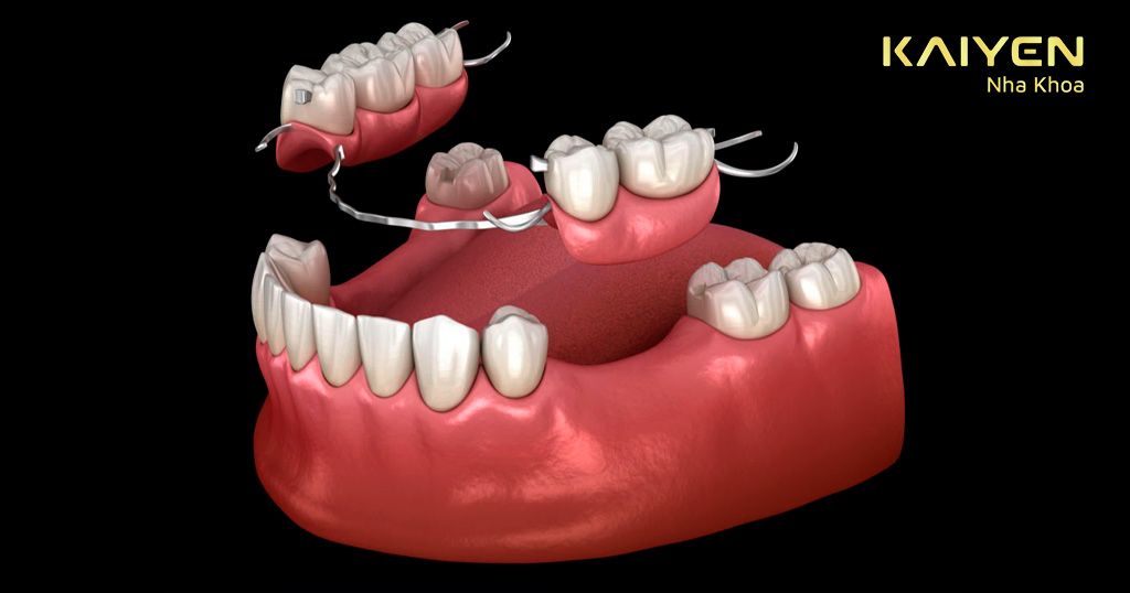 Dùng hàm giả tháo lắp bán phần để phục hồi những vị trí răng bị mất