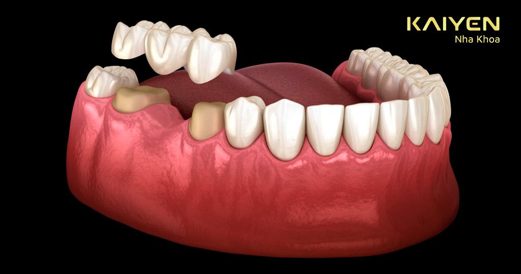Trồng răng có đau không khi sử dụng phương pháp làm cầu răng sứ?
