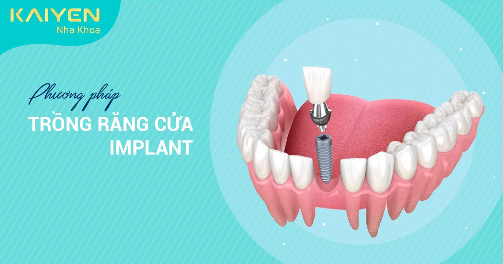 Trồng răng cửa Implant: Loại nào tốt nhất và giá bao nhiêu?