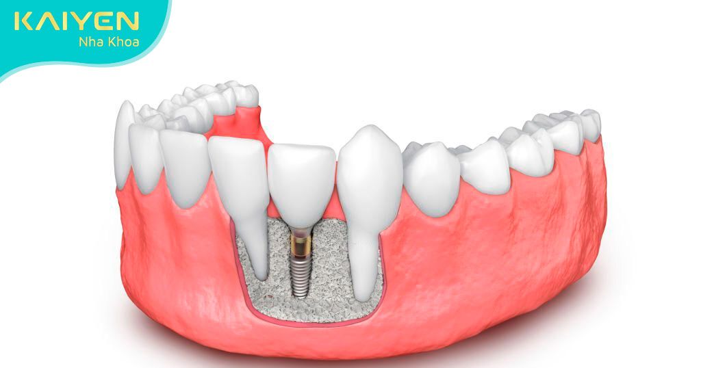 Cấy ghép Implant cho răng cửa