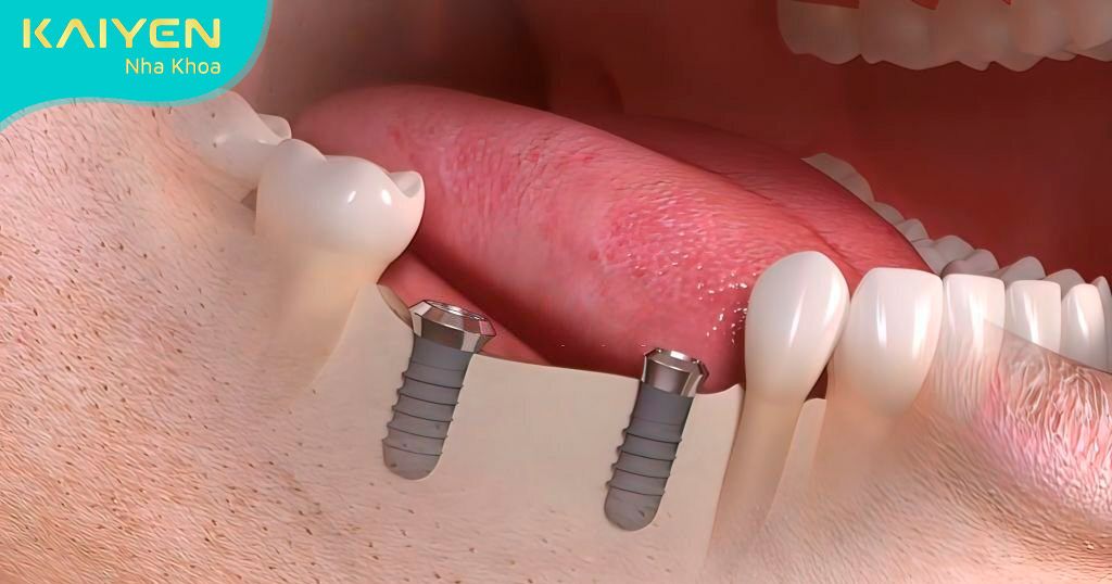 Giá trồng răng cửa phụ thuộc vào tình trạng răng miệng