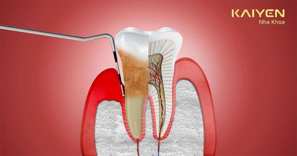 Trồng răng giúp ngăn ngừa mắc các bệnh về răng miệng như viêm nha chu