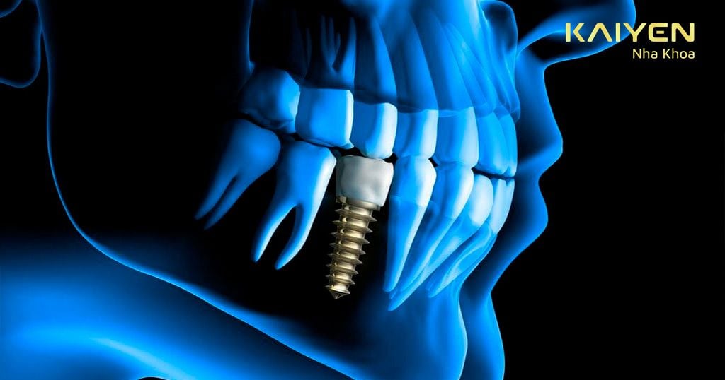 Trồng 1 răng bằng cấy ghép Implant là phương pháp phục hình đắt đỏ nhất