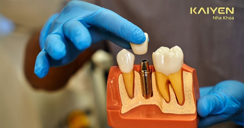 Chọn bác sĩ có tay nghề giỏi để tránh phát sinh chi phí khắc phục trồng răng không chuẩn