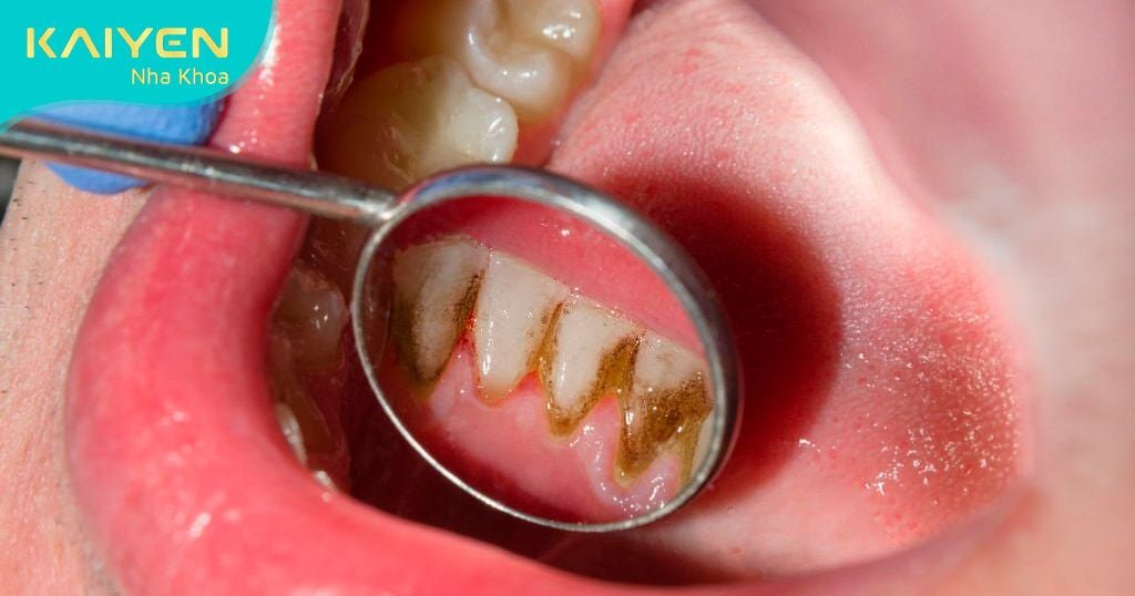 Vệ sinh răng miệng kém gây tích tụ mảng bám cao răng
