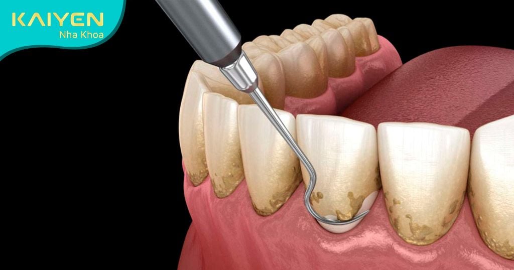 Lấy cao răng làm sạch vi khuẩn gây hôi miệng