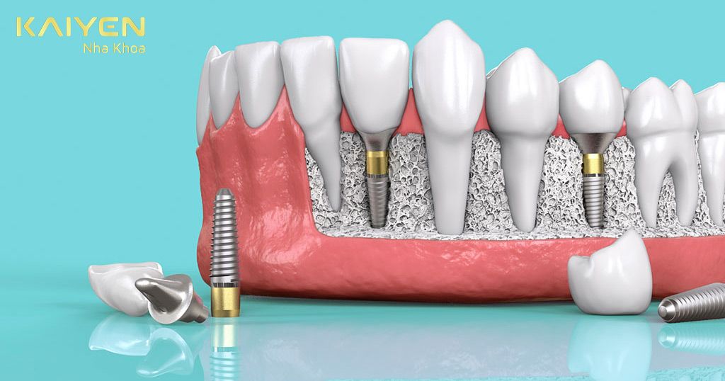 Trồng răng giả cố định bằng cấy ghép Implant