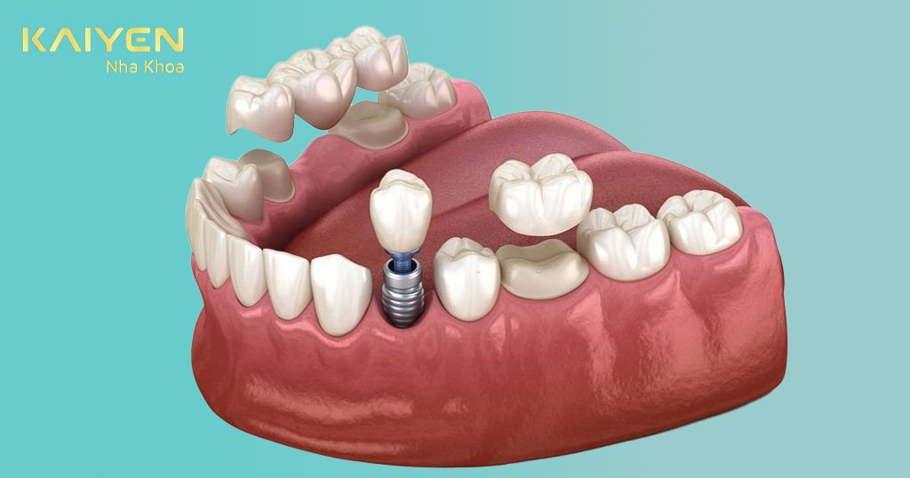 Trồng răng cố định giá bao nhiêu còn phụ thuộc vào nhiều yếu tố