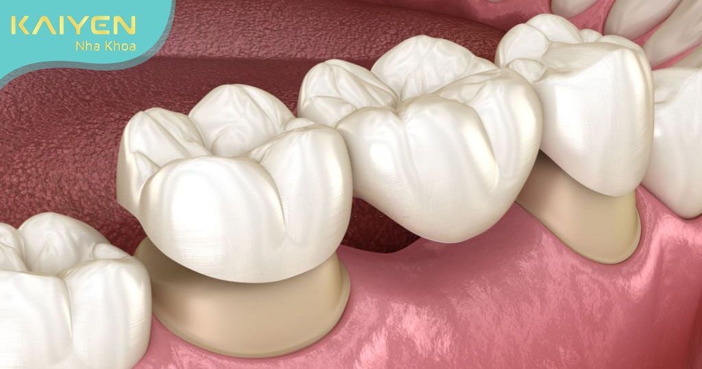 Cầu răng sứ gây ảnh hưởng đến hai chiếc răng bên cạnh