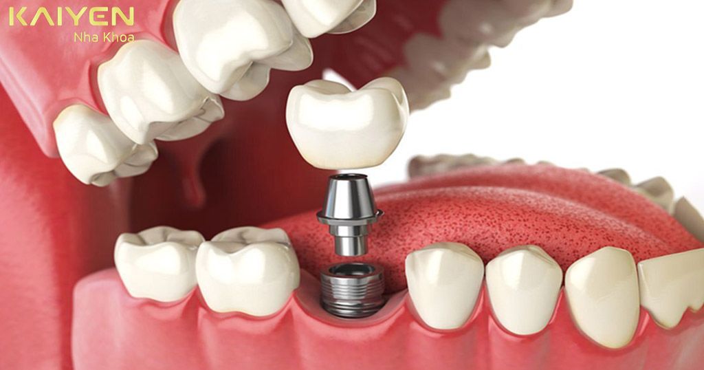 Trồng răng bằng phương pháp cấy Implant