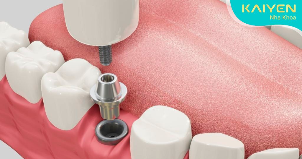 Trồng răng hàm bằng Implant có tốt không? Chi phí bao nhiêu?