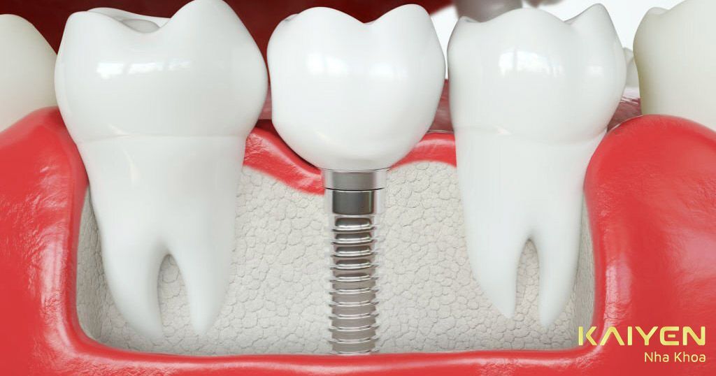 Cấy ghép Implant cho răng hàm số 6 bị mất