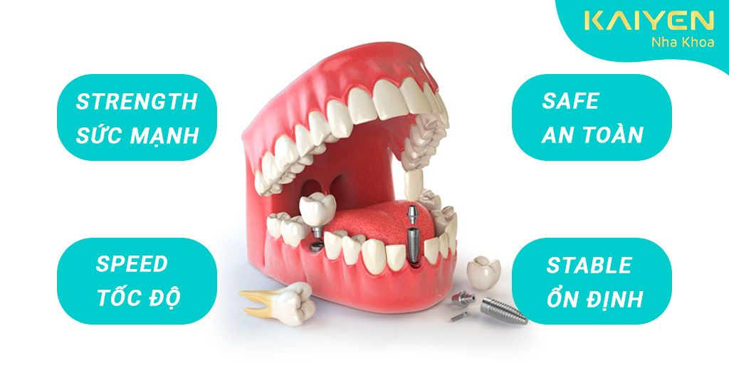Cấy răng Implant 4s hoàn hảo với nhiều ưu điểm